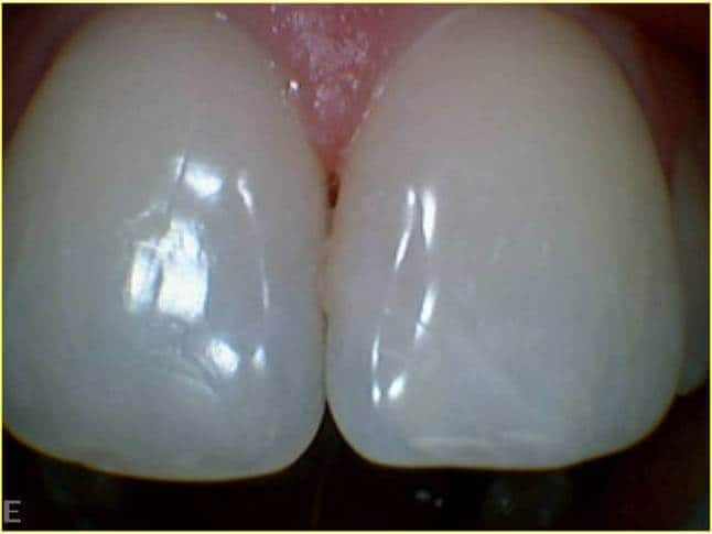 Dentists at Pymble Customer Case Study Broken Teeth After Dental Treatment