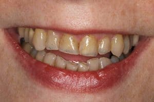 Dentists at Pymble Dental Team - Lemon Water and Dental Health Teeth - Before Dental Treatments