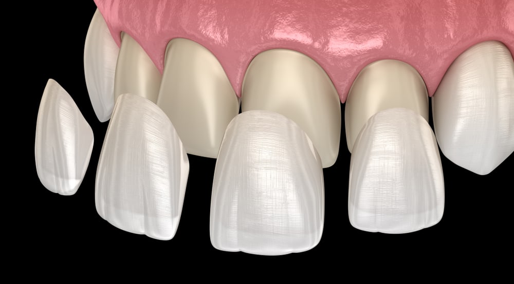 A Comprehensive Guide to Different Types of Veneers
