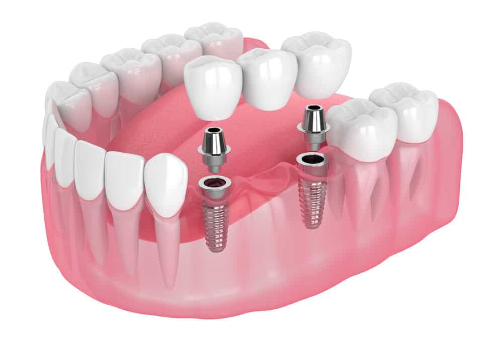 Dental Implants 101: Cost, Procedure, and Aftercare