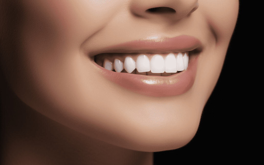 The Lifespan of Dental Veneers: What to Expect