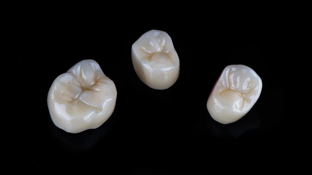 The Ultimate Guide to Dental Crowns: How Long Do They Really Last?